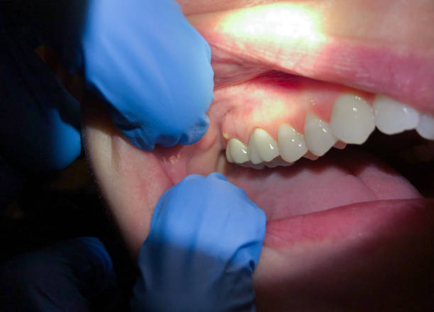 Best Teeth Whitening  in Salmon, ID